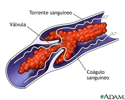 Co&aacute;gulo de sangre venoso
