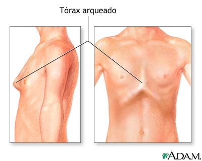 T&oacute;rax arqueado (pecho de paloma)