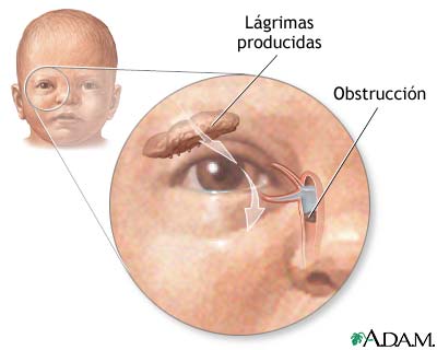 Obstrucci&oacute;n del conducto lagrimal