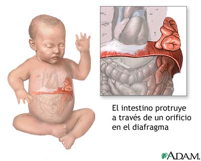 Hernia diafragm&aacute;tica infantil