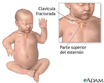 Clav&iacute;cula fracturada en un reci&eacute;n nacido