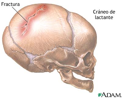 Fractura de cr&aacute;neo en lactante