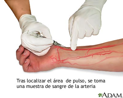 Muestra de sangre arterial