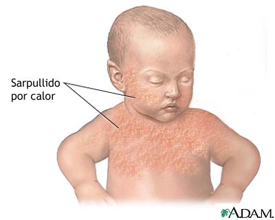 Erupci&oacute;n por calor del beb&eacute;
