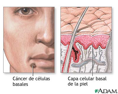 C&aacute;ncer de c&eacute;lulas basales