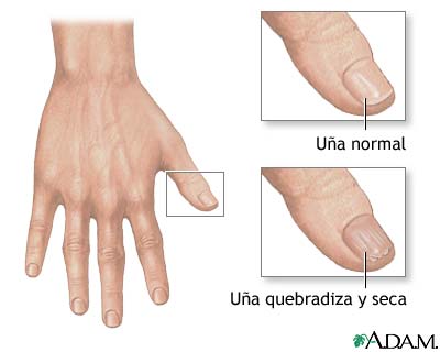 U&ntilde;as quebradizas