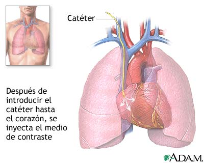 Cateterizaci&oacute;n card&iacute;aca