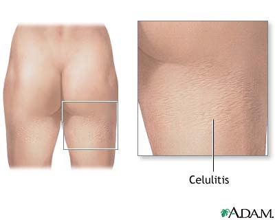 Celulitis