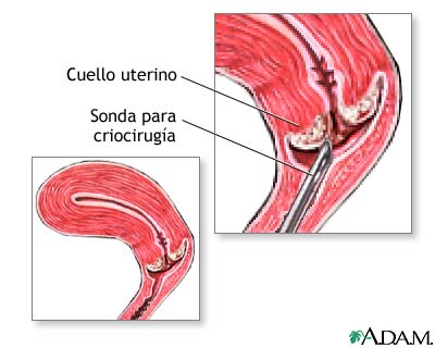 Criocirug&iacute;a cervical