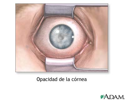 C&oacute;rnea nublada