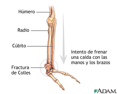 Fractura de Colles