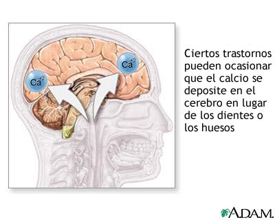 Calcificaci&oacute;n craneal