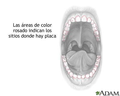 Coloraci&oacute;n de la placa dental