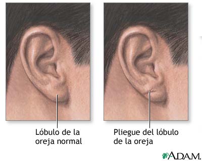 Pliegue del l&oacute;bulo de la oreja