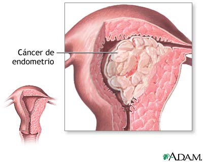 C&aacute;ncer endometrial