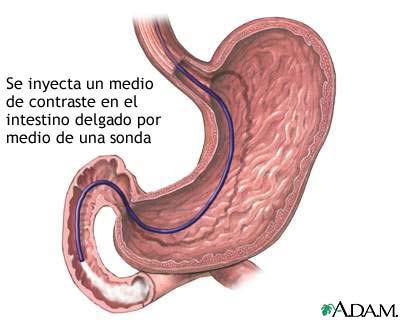 Inyecci&oacute;n de contraste en el intestino delgado