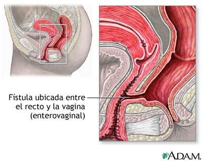 F&iacute;stula