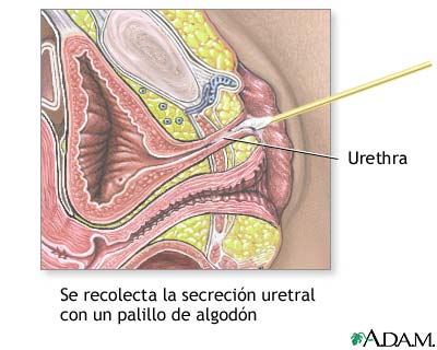 Tinci&oacute;n de gram de la secreci&oacute;n uretral