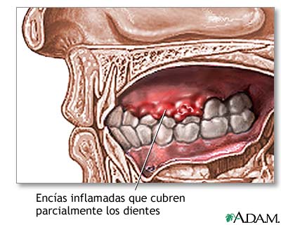 Enc&iacute;as inflamadas