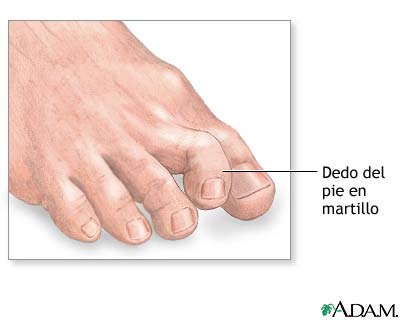 Dedo de pie en martillo