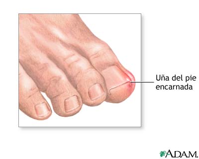U&ntilde;a del pie encarnada