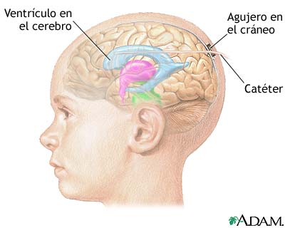 Monitoreo de la presi&oacute;n intracraneal