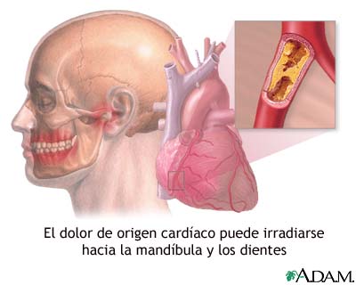 Dolor de mand&iacute;bula y ataques card&iacute;acos