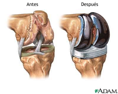 Pr&oacute;tesis de reemplazo de la articulaci&oacute;n de la rodilla