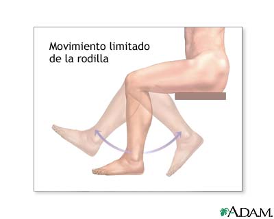 Rango de movimiento limitado