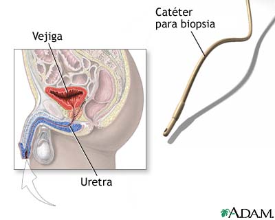 Biopsia de vejiga