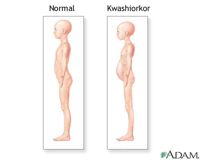 S&iacute;ntomas de Kwashiorkor