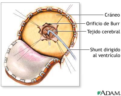 Craneotom&iacute;a para derivaci&oacute;n cerebral