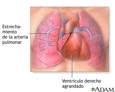 Hipertensi&oacute;n pulmonar primaria