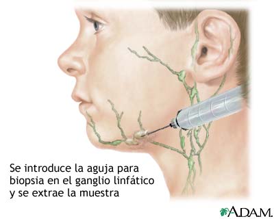 Cultivo de ganglio linf&aacute;tico