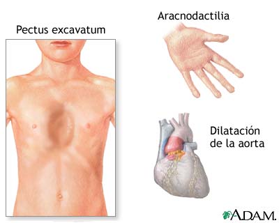 S&iacute;ndrome de Marfan