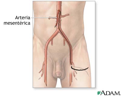 Arteriograf&iacute;a mesent&eacute;rica