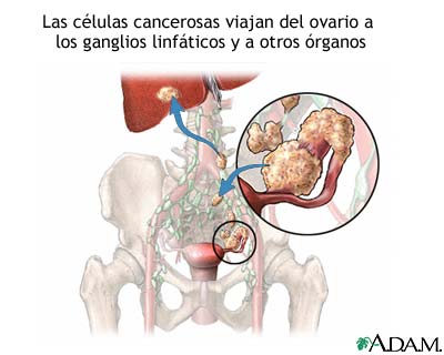 Met&aacute;stasis de c&aacute;ncer ov&aacute;rico