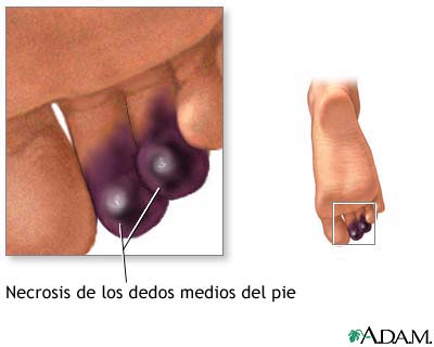Necrosis de los dedos de los pies