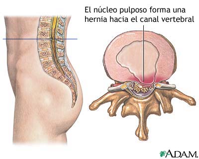 N&uacute;cleo pulposo herniado
