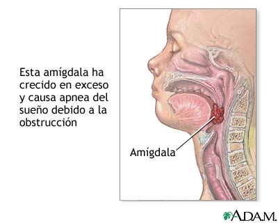 Apnea obstructiva del sue&ntilde;o