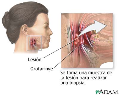 Biopsia orofar&iacute;ngea