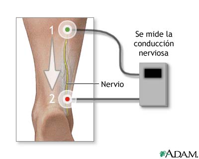 Prueba de conducci&oacute;n nerviosa