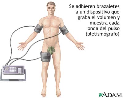 Pletismograf&iacute;a