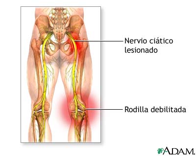 Da&ntilde;o al nervio ci&aacute;tico
