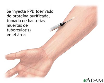 Examen cut&aacute;neo de PPD