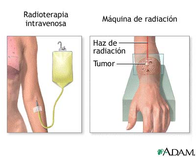 Terapia de radiaci&oacute;n