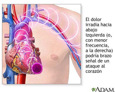 S&iacute;ntomas de un ataque card&iacute;aco