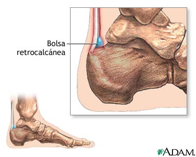 Bursitis retrocalc&aacute;nea