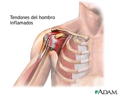 Tendones del hombro inflamados