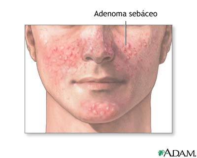 Adenoma seb&aacute;ceo